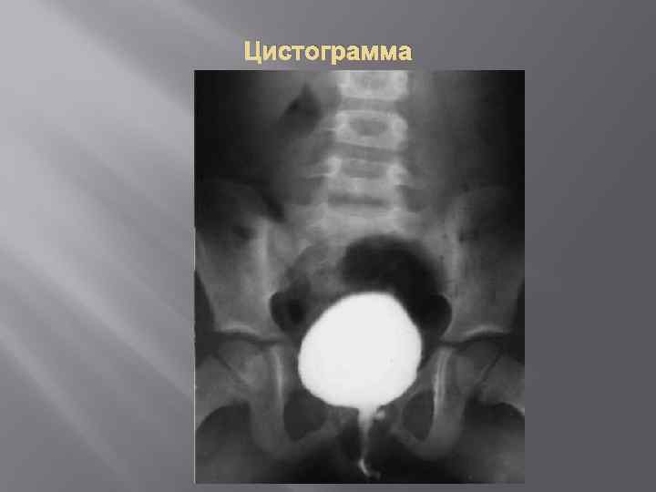 Цистограмма 