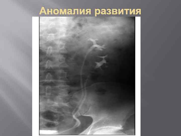 Аномалия развития 