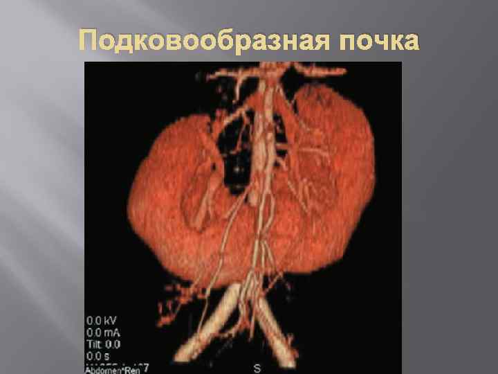 Подковообразная почка 