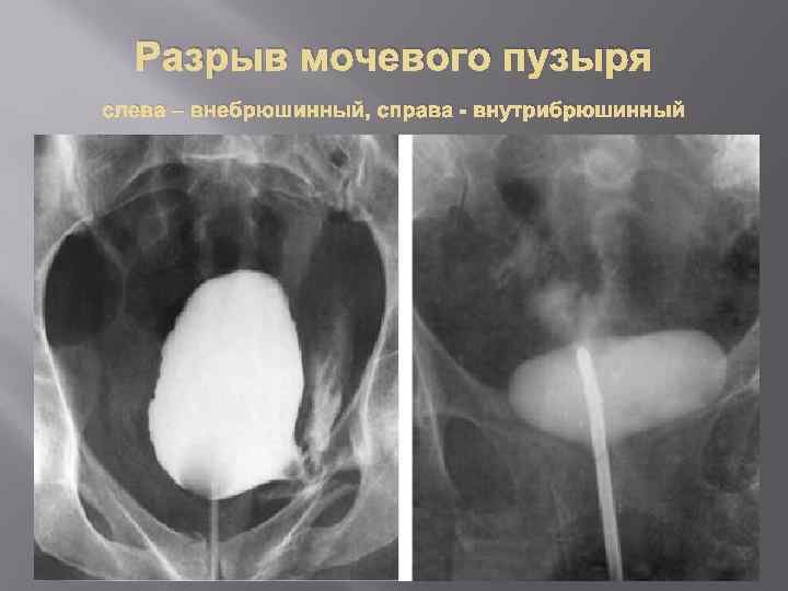 Разрыв мочевого пузыря слева – внебрюшинный, справа - внутрибрюшинный 