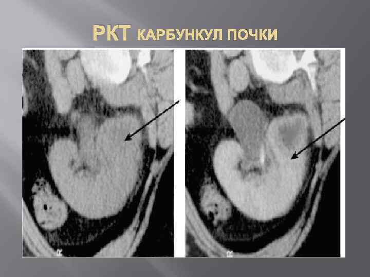 РКТ КАРБУНКУЛ ПОЧКИ 