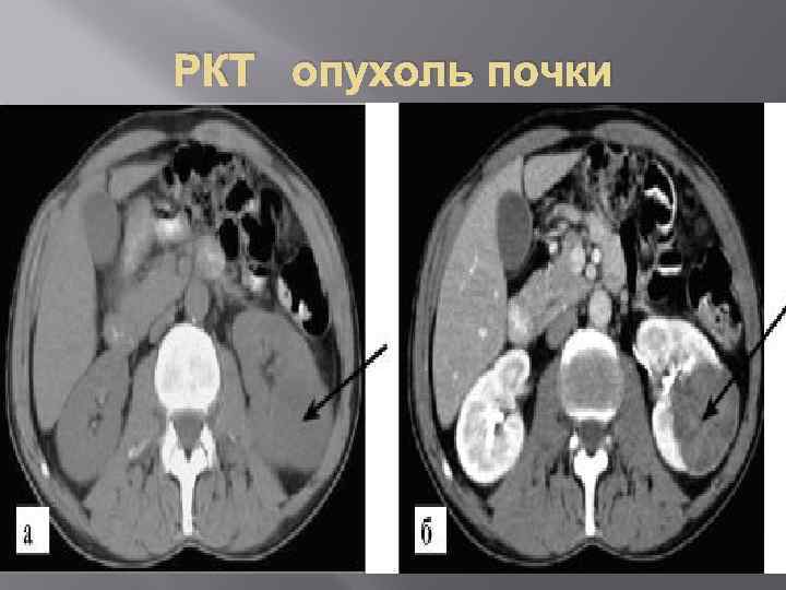РКТ опухоль почки 
