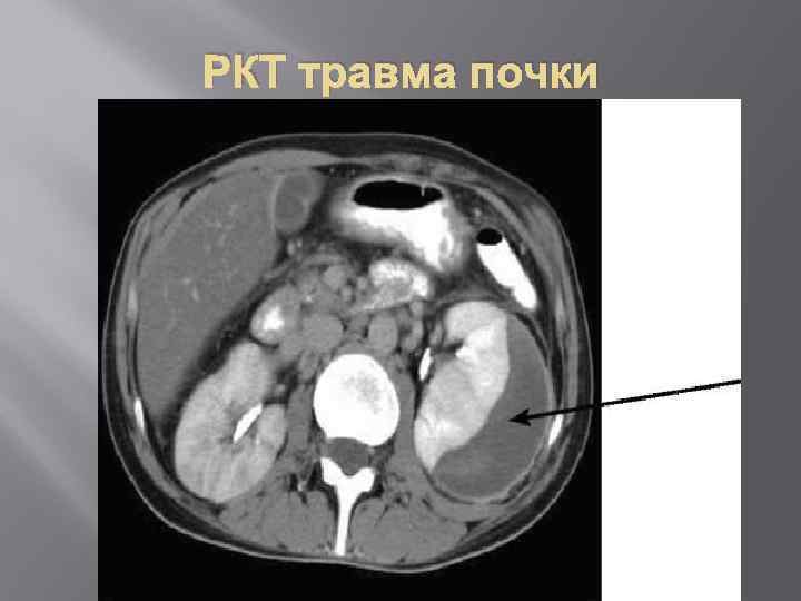 РКТ травма почки 