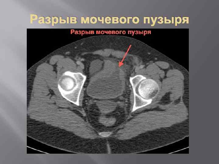 Разрыв мочевого пузыря 