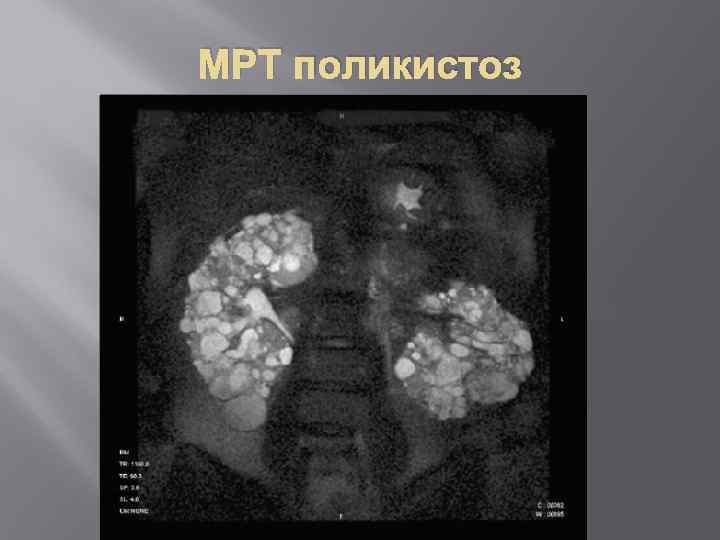 МРТ поликистоз 
