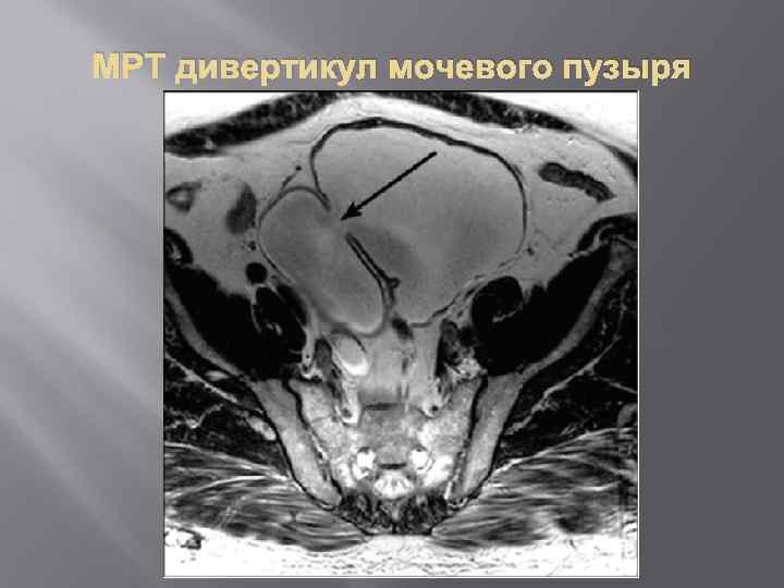 МРТ дивертикул мочевого пузыря 