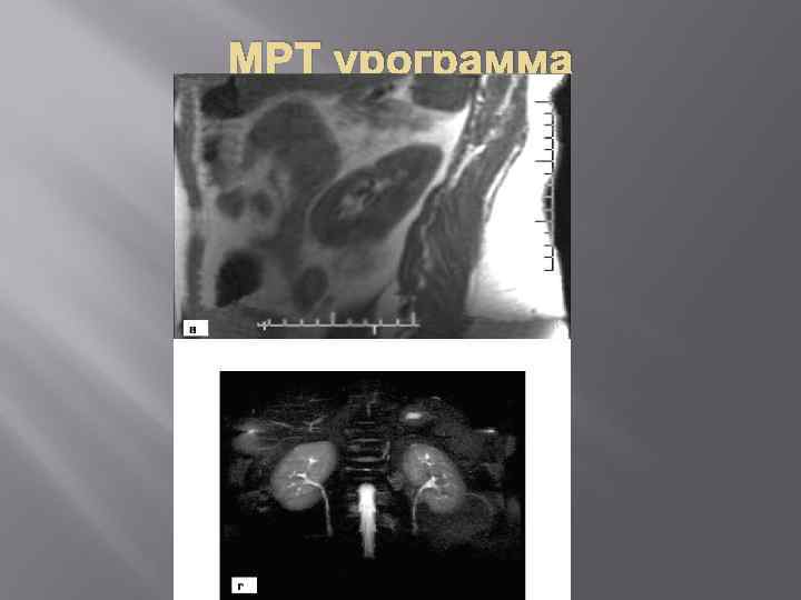 МРТ урограмма 