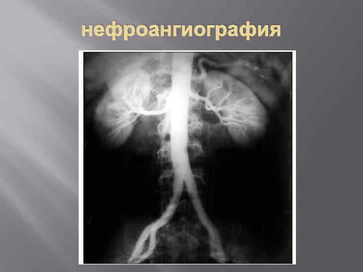 нефроангиография 