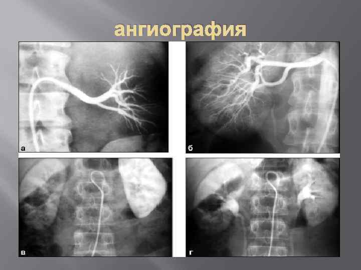 ангиография 