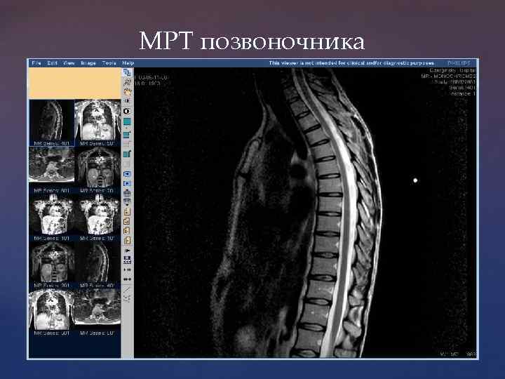 МРТ позвоночника 