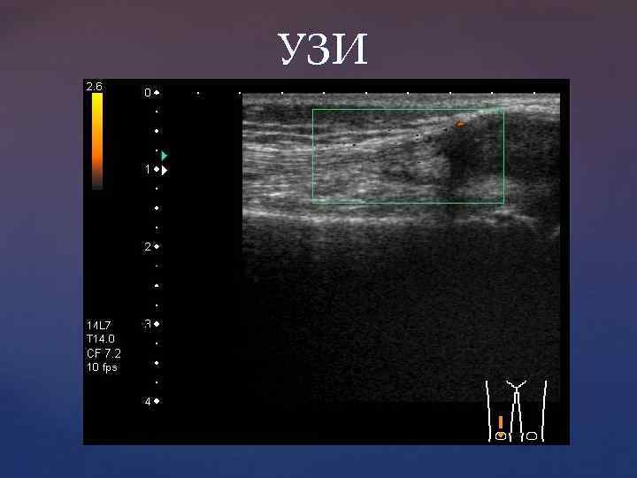 УЗИ 