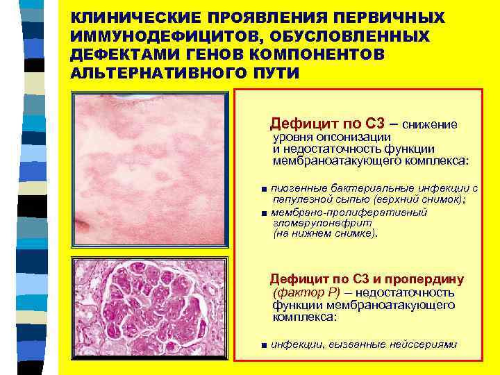 КЛИНИЧЕСКИЕ ПРОЯВЛЕНИЯ ПЕРВИЧНЫХ ИММУНОДЕФИЦИТОВ, ОБУСЛОВЛЕННЫХ ДЕФЕКТАМИ ГЕНОВ КОМПОНЕНТОВ АЛЬТЕРНАТИВНОГО ПУТИ Дефицит по С 3