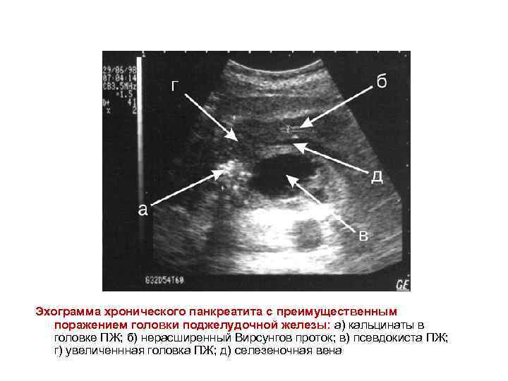 Эхограмма хронического панкреатита с преимущественным поражением головки поджелудочной железы: а) кальцинаты в головке