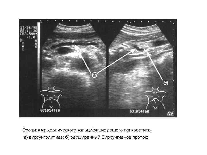 Эхограмма хронического кальцифицирующего панкреатита: а) вирсунголитиаз; б) расширенный Вирсунгианов проток; 