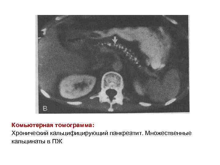 Комьютерная томограмма: Хронический кальцифицирующий панкреатит. Множественные кальцинаты в ПЖ 