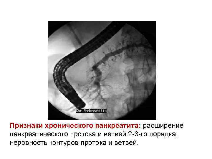 Признаки хронического панкреатита: расширение панкреатического протока и ветвей 2 -3 -го порядка, неровность контуров