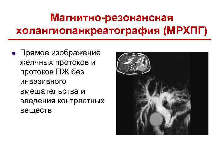 Мрхпг это. МРХПГ хронический панкреатит. МРХПГ поджелудочной железы. Холангиопанкреатография МРХПГ. Магнитно резонансная холангиопанкреатография МРХПГ.