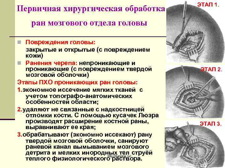 Первичная хирургическая обработка ЭТАП 1. ран мозгового отдела головы n Повреждения головы: закрытые и