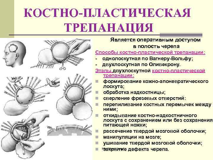 КОСТНО-ПЛАСТИЧЕСКАЯ ТРЕПАНАЦИЯ Является оперативным доступом в полость черепа Способы костно-пластической трепанации: - однолоскутная по