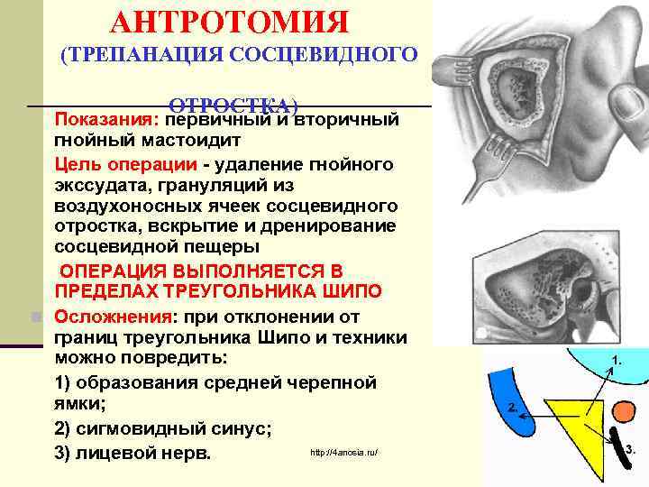 АНТРОТОМИЯ (ТРЕПАНАЦИЯ СОСЦЕВИДНОГО ОТРОСТКА) Показания: первичный и вторичный гнойный мастоидит Цель операции - удаление