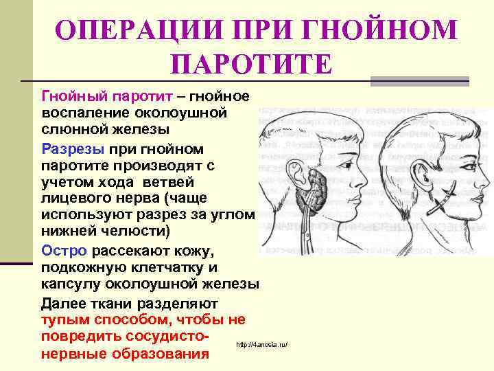 ОПЕРАЦИИ ПРИ ГНОЙНОМ ПАРОТИТЕ Гнойный паротит – гнойное воспаление околоушной слюнной железы Разрезы при