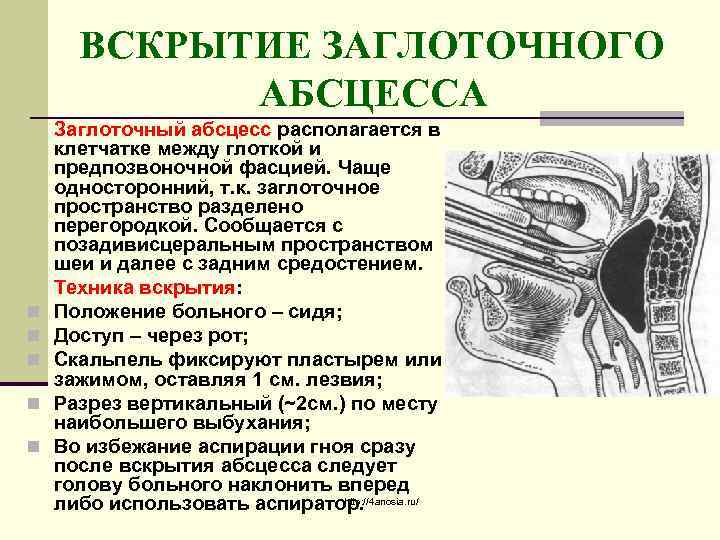 ВСКРЫТИЕ ЗАГЛОТОЧНОГО АБСЦЕССА n n n Заглоточный абсцесс располагается в клетчатке между глоткой и