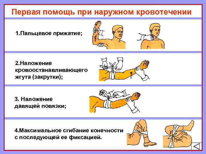 Первая помощь при наружном кровотечении 1. Пальцевое прижатие; 2. Наложение кровоостанавливающего жгута (закрутки); 3.