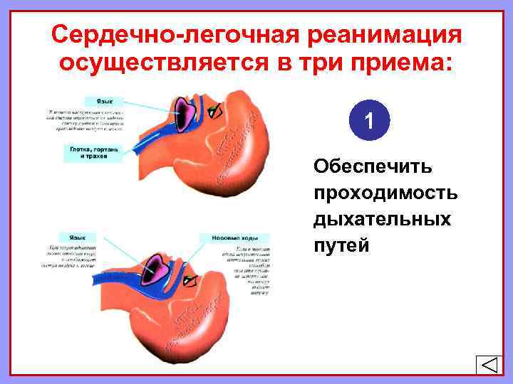 Сердечно-легочная реанимация осуществляется в три приема: 1 Обеспечить проходимость дыхательных путей 