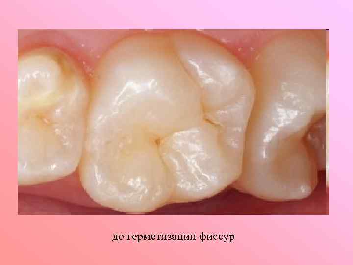 до герметизации фиссур 