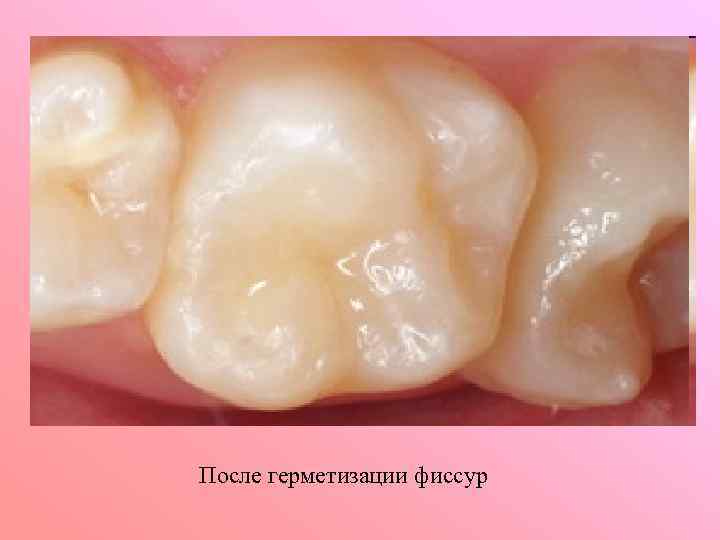 После герметизации фиссур 