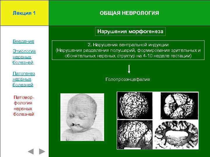 Лекция 1 ОБЩАЯ НЕВРОЛОГИЯ Нарушения морфогенеза Введение Этиология нервных болезней Патогенез нервных болезней Патоморфология