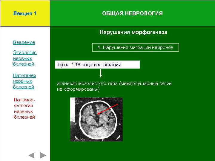 Лекция 1 ОБЩАЯ НЕВРОЛОГИЯ Нарушения морфогенеза Введение 4. Нарушения миграции нейронов Этиология нервных болезней