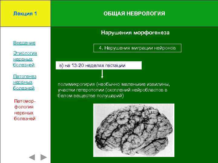 Лекция 1 ОБЩАЯ НЕВРОЛОГИЯ Нарушения морфогенеза Введение Этиология нервных болезней Патогенез нервных болезней Патоморфология