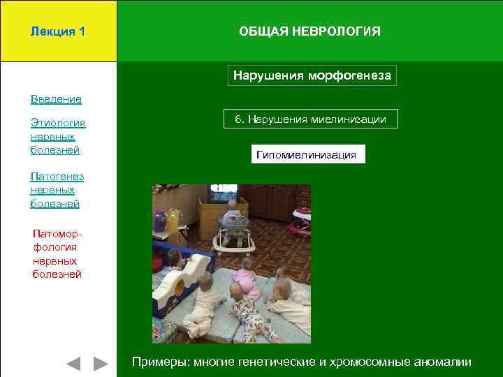 Лекция 1 ОБЩАЯ НЕВРОЛОГИЯ Нарушения морфогенеза Введение Этиология нервных болезней 6. Нарушения миелинизации Гипомиелинизация
