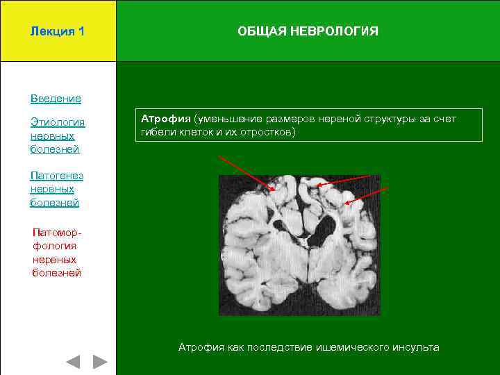 Лекция 1 ОБЩАЯ НЕВРОЛОГИЯ Введение Этиология нервных болезней Атрофия (уменьшение размеров нервной структуры за