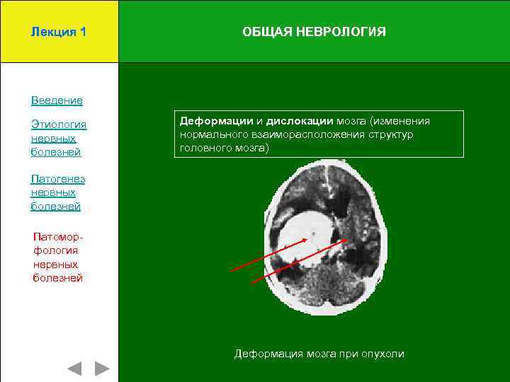 Лекция 1 ОБЩАЯ НЕВРОЛОГИЯ Введение Этиология нервных болезней Деформации и дислокации мозга (изменения нормального