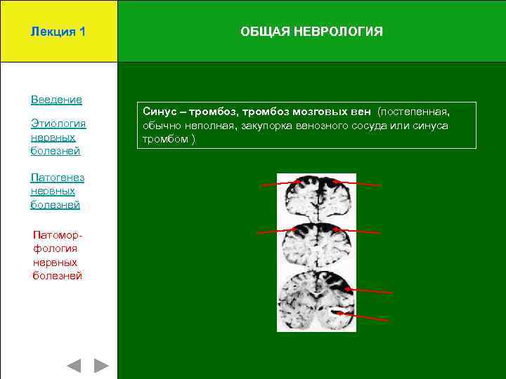 Лекция 1 Введение Этиология нервных болезней Патогенез нервных болезней Патоморфология нервных болезней ОБЩАЯ НЕВРОЛОГИЯ