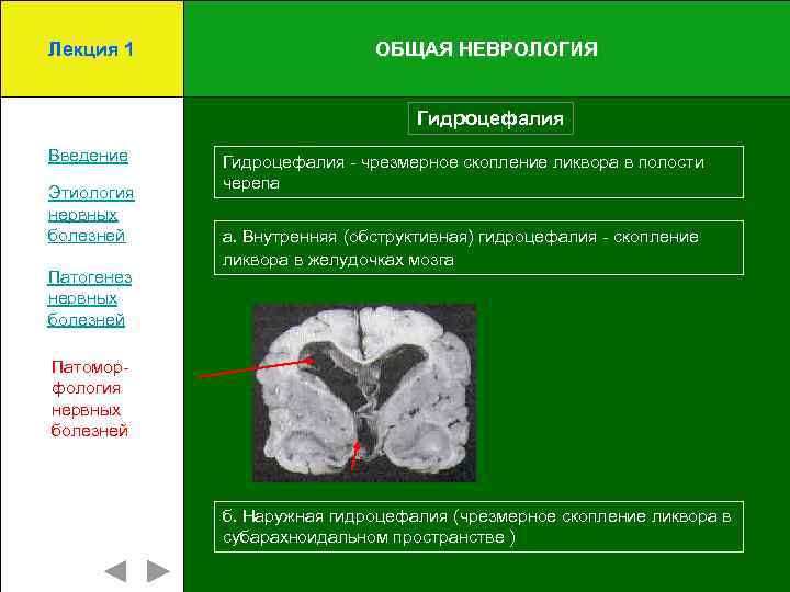 Лекция 1 ОБЩАЯ НЕВРОЛОГИЯ Гидроцефалия Введение Этиология нервных болезней Патогенез нервных болезней Гидроцефалия -