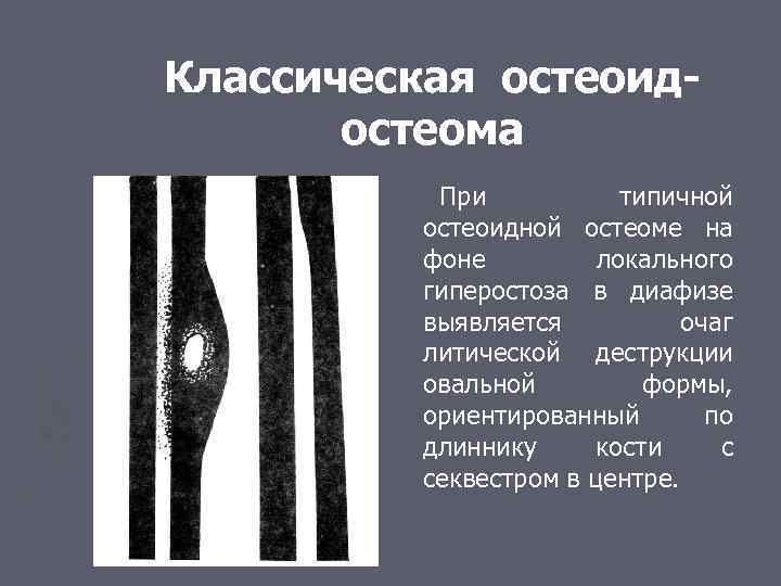 Классическая остеоидостеома При типичной остеоидной остеоме на фоне локального гиперостоза в диафизе выявляется очаг