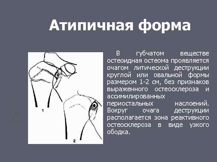 Атипичная форма В губчатом веществе остеоидная остеома проявляется очагом литической деструкции круглой или овальной