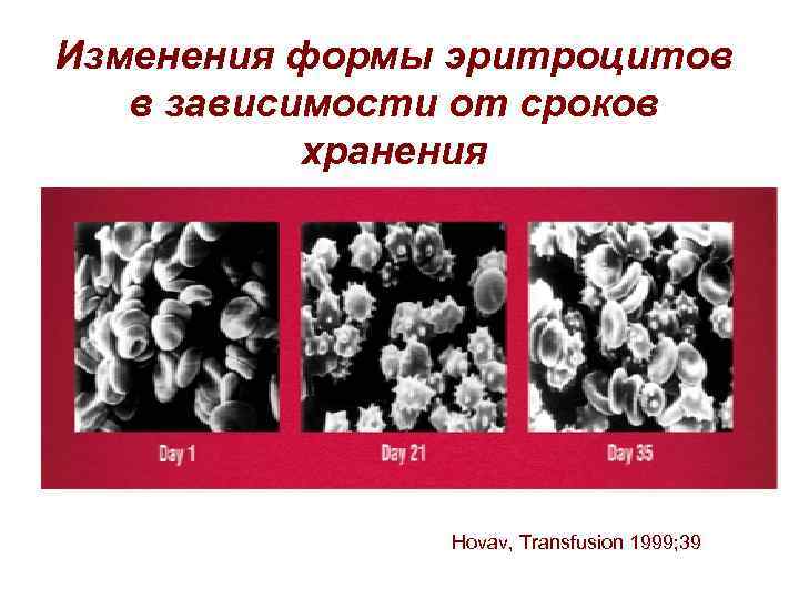 Изменения формы эритроцитов в зависимости от сроков хранения Hovav, Transfusion 1999; 39 