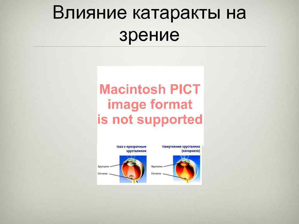 Влияние катаракты на зрение 