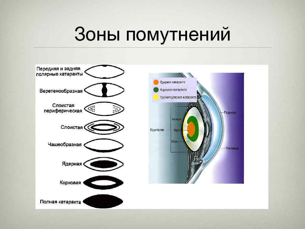 Зоны помутнений 