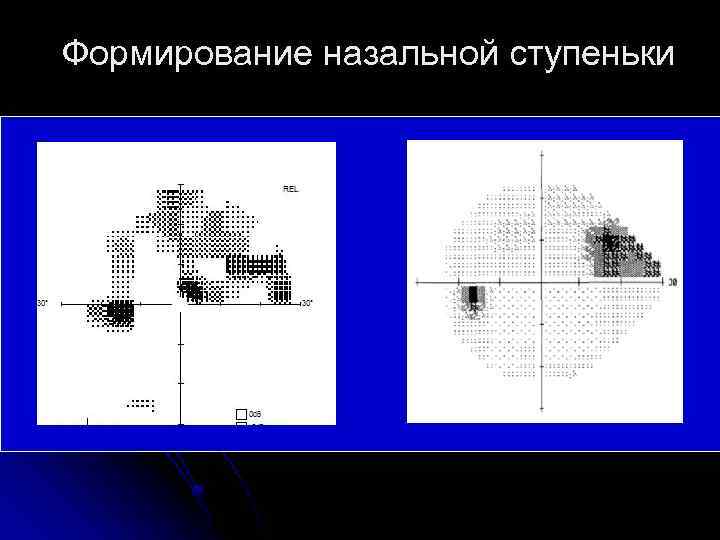 Формирование назальной ступеньки 