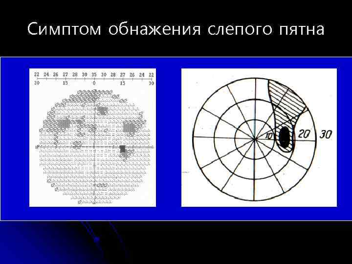 Симптом обнажения слепого пятна 