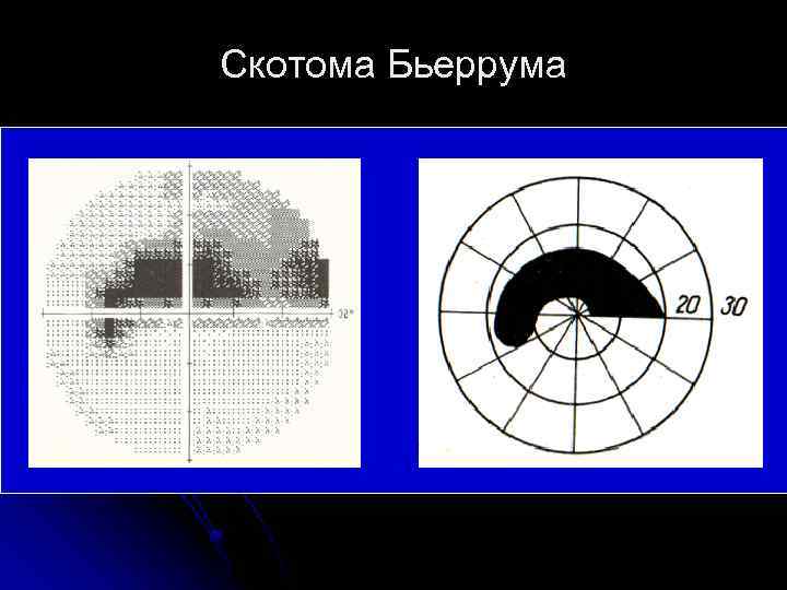 Скотома Бьеррума 