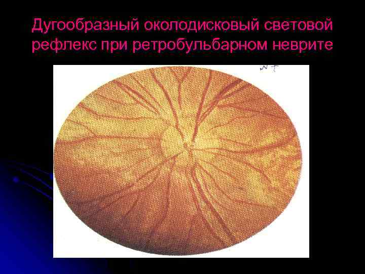 Дугообразный околодисковый световой рефлекс при ретробульбарном неврите 