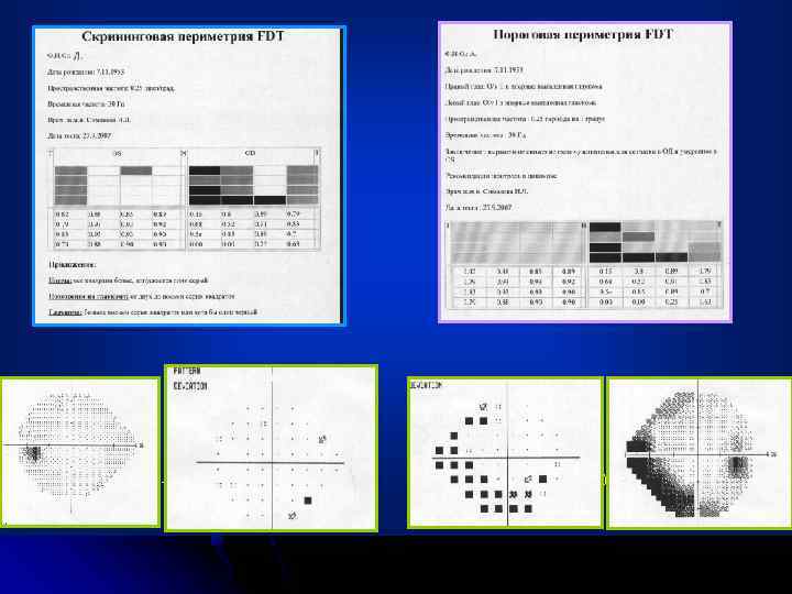 OS OD MD= - 1, 75 DB p < 10% MD = -