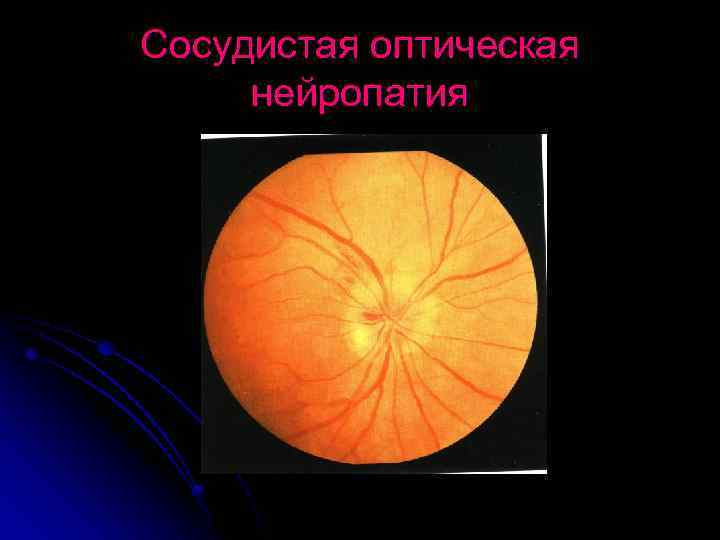 Сосудистая оптическая нейропатия 