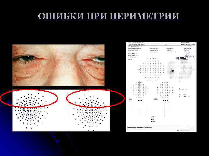 ОШИБКИ ПРИ ПЕРИМЕТРИИ 